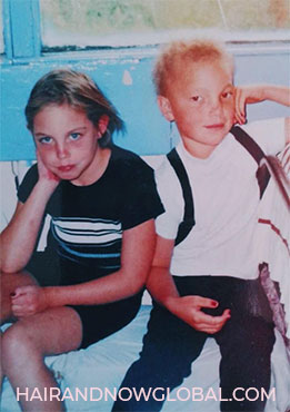 Girl-with-Alopecia-age-8-with-girl-with-normal-hair also aged 8